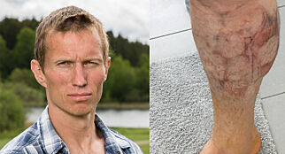 Birkebeinerrennet endte i smertehelvete for «Farmen»-Frank